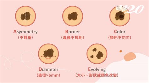 手掌痣|別把癌當痣！5部位冒黑點恐是惡性黑色素瘤 台大醫師。